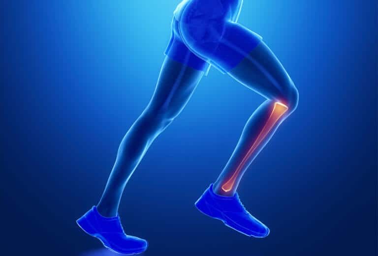 Periostitis Tibial Al Correr Causas S Ntomas Y Tramtamiento