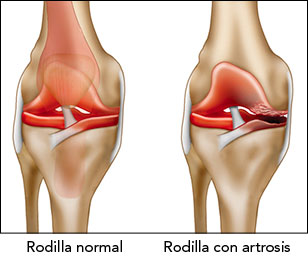 Tratamiento artrosis de rodilla