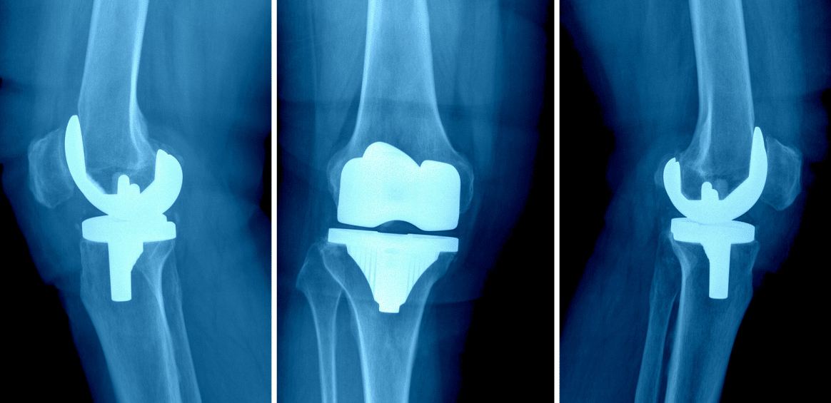 Artroplastia: ¿Me Opero? - Clínica Martín Gómez Traumatólogos