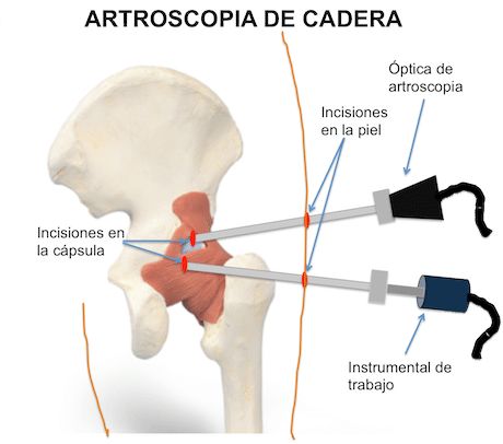 Artroscopia de cadera
