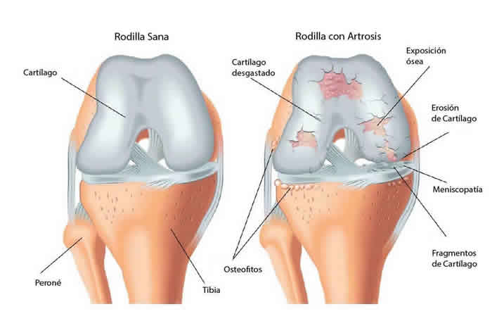 Artrosis de rodilla, traumatólogo Granada