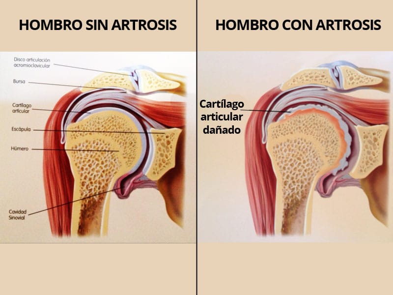 Tu traumatólogo en Granada para la artrosis de hombro