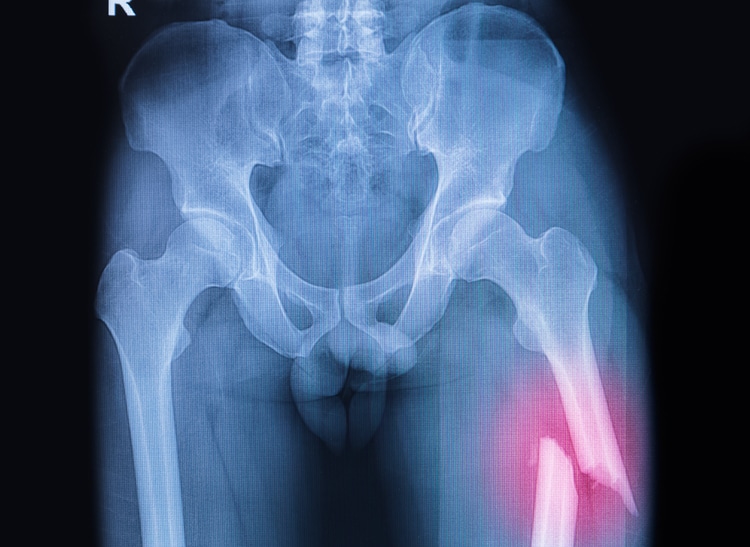 síntomas de la osteoporosis
