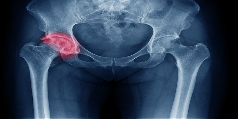 ¿Qué es una fractura de cadera? causas, síntomas y tratamiento