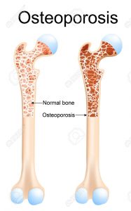 hueso normal y con osteoporosis
