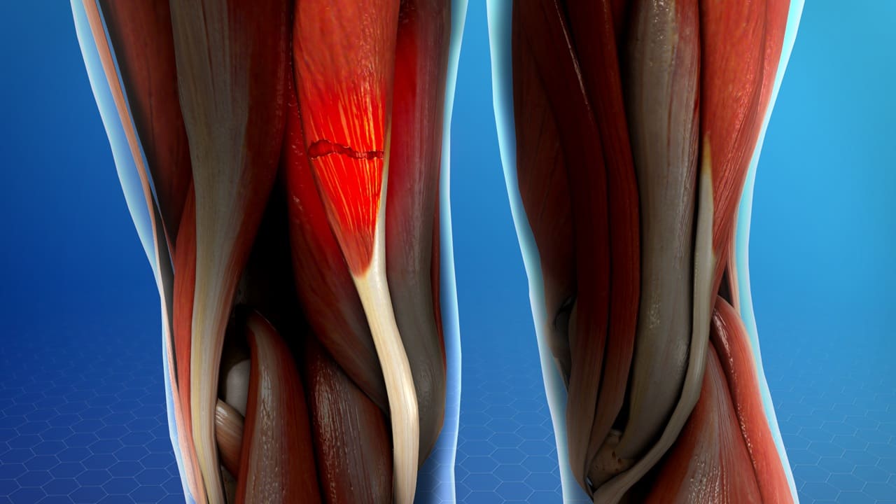 Lesiones en el bíceps femoral