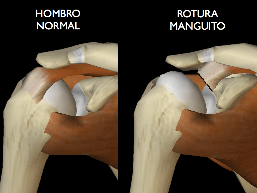 Rotura Del Manguito De Los Rotadores Cl Nica Mart N G Mez