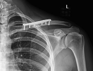 radiografía operación fractura de clavícula