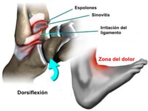 Inflamacion de tobillo con dolor