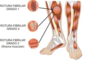 Lesiones musculares: Rotura fibrilar